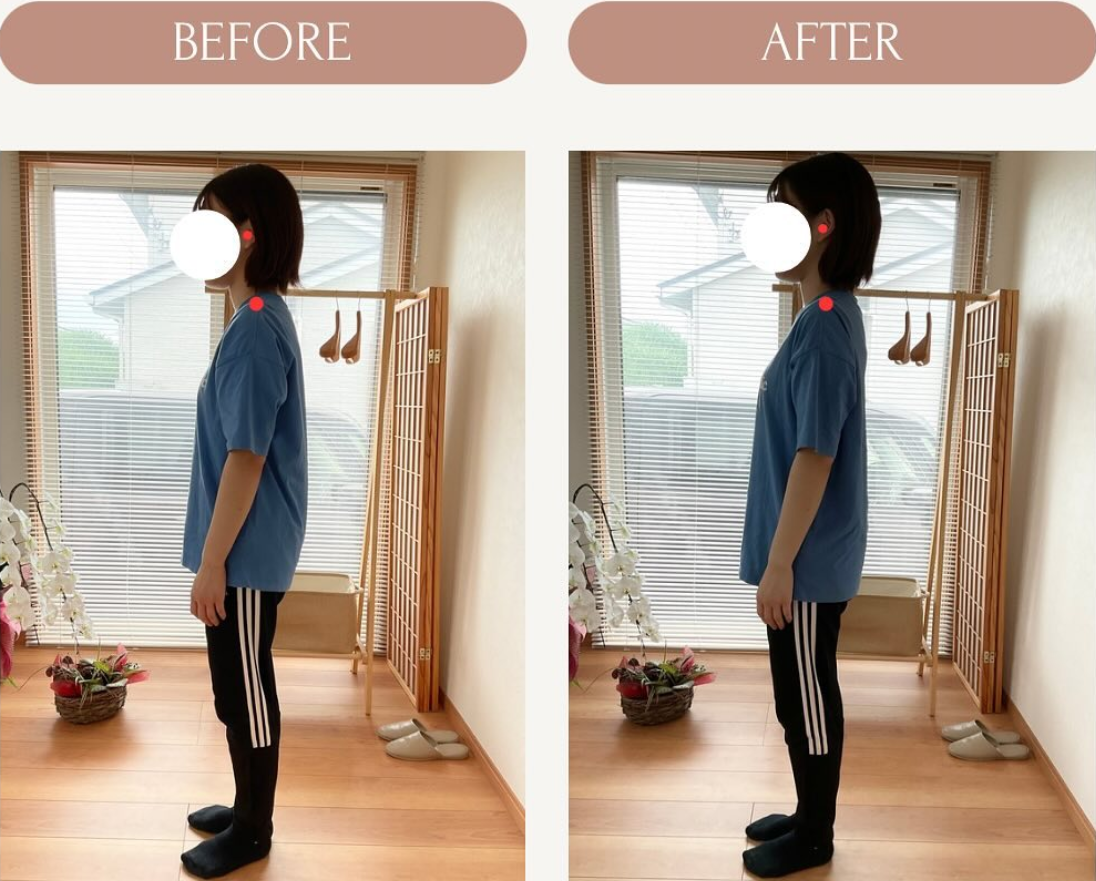 首と肩の位置を施術前後で比較した写真