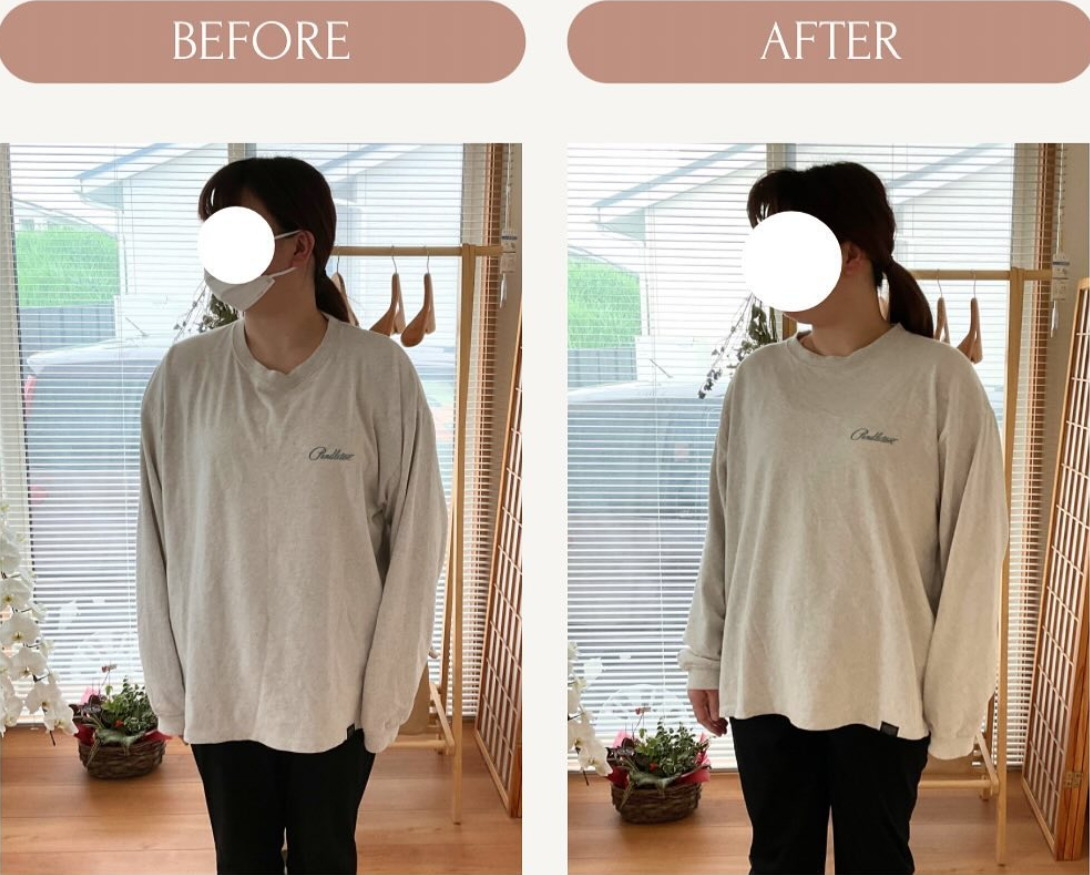 肩の高さと身体の向きを施術前後で比較した写真
